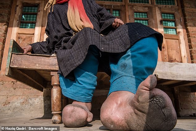 Bàn chân sưng to gấp 3 lần vì nhiễm giun sán khiến cô gái 21 tuổi có khả năng mất cả tương lai-3