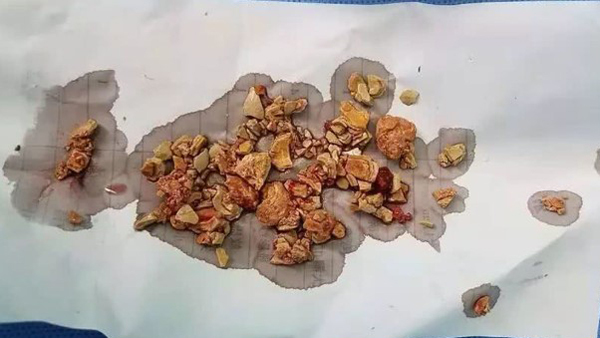 Bé 5 tháng tiểu ra máu, thận đầy sỏi do mẹ cai sữa sớm-2