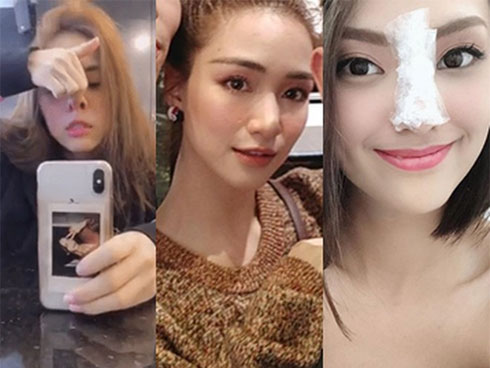 Hết cấy tóc, giờ đây còn xuất hiện dịch vụ... cắt bỏ dα đầu để sửα trán bớt cao-6