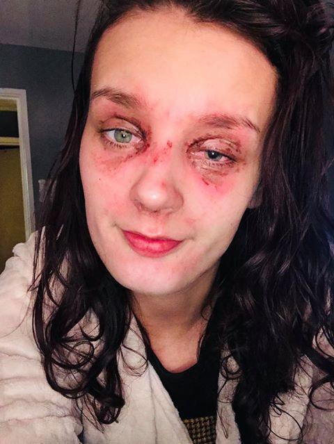 Hí hửng mở lò vi sóng, cô gái hứng trọn cú nổ kinh hoàng suýt mù mắt vì hành động nhiều người vô tư làm-2