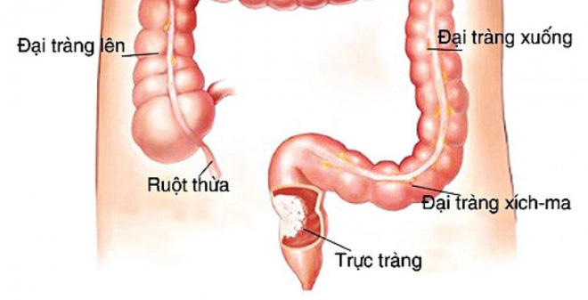 Tỷ lệ mắc ung thư ruột tăng 50% sau 10 năm: 3 yếu tố gây bệnh nhiều người đang coi nhẹ-1