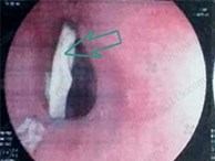 Hóc xương gà, cụ ông bị thủng thực quản suýt chết