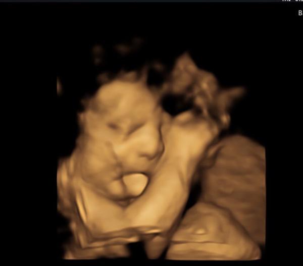 Hào hứng khen bé lè lưỡi đáng yêu khi siêu âm, ngày sinh ra mẹ thẫn thờ nhìn mặt con-1