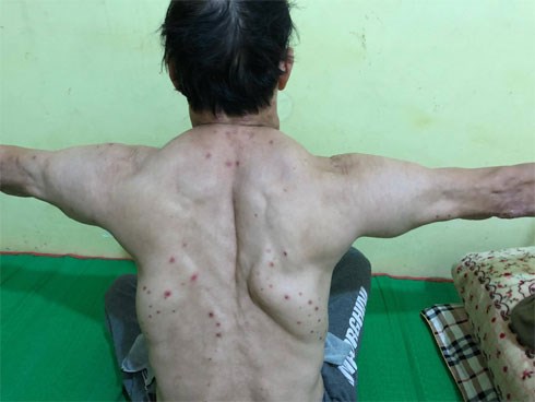 Uống rượu nhiều năm, 3 người đàn ông mắc bệnh lạ, khối u khủng mọc chi chít