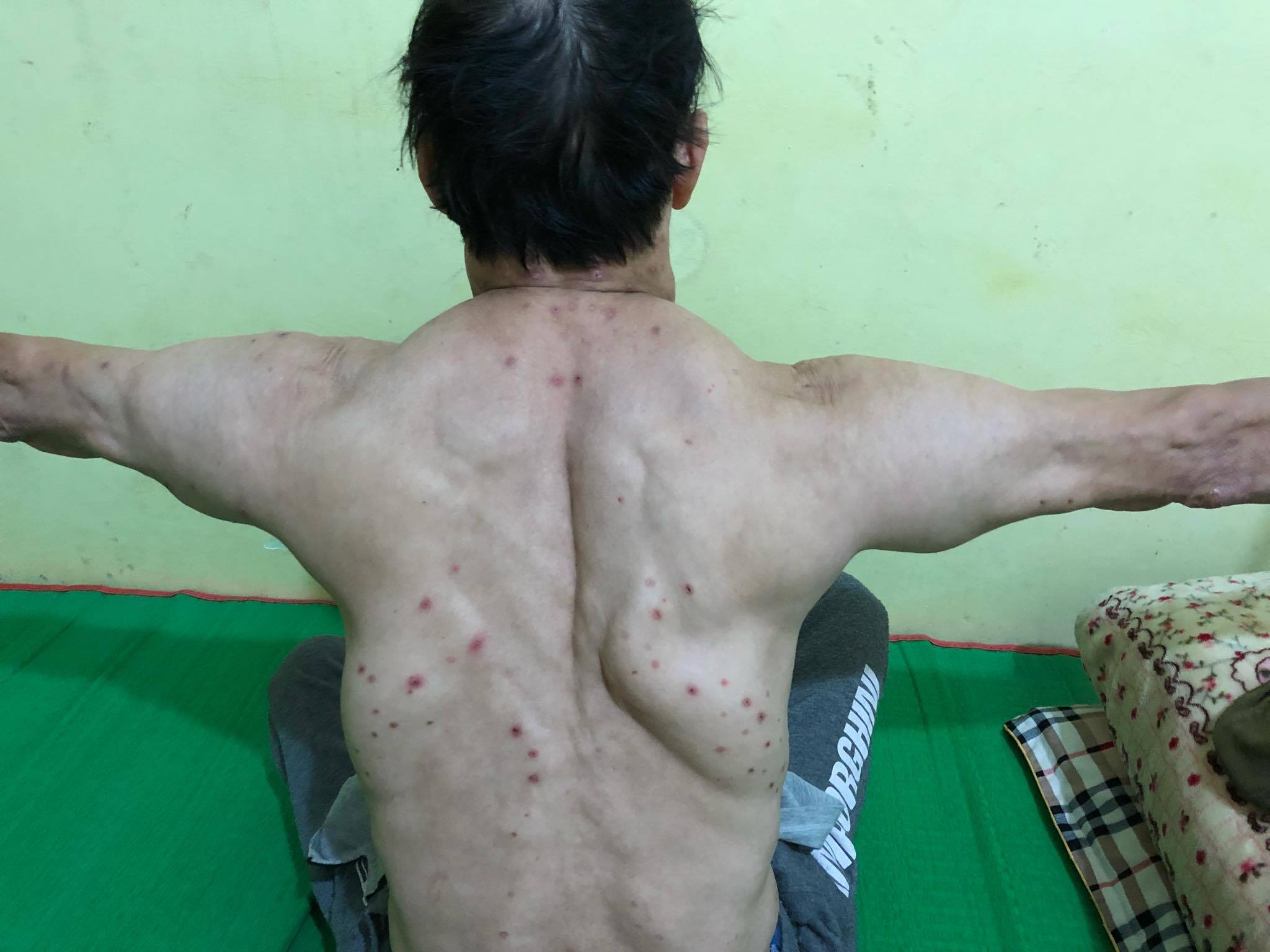 Uống rượu nhiều năm, 3 người đàn ông mắc bệnh lạ, khối u khủng mọc chi chít-1