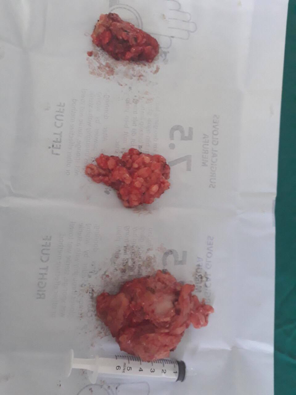 Uống rượu nhiều năm, 3 người đàn ông mắc bệnh lạ, khối u khủng mọc chi chít-3