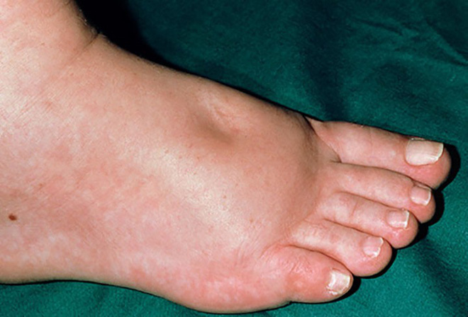 Bàn chân xuất hiện cùng lúc 3 dấu hiệu này: Hãy cảnh giác vì có thể thận đang có bệnh-1