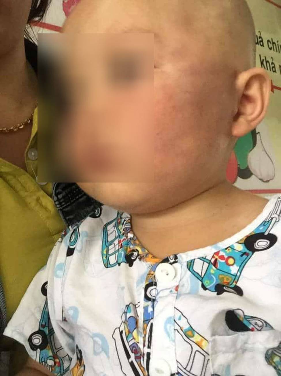 Vĩnh Long: Bé trai 19 tháng tuổi bị bảo mẫu tát liên tục vào mặt, phải nhập viện điều trị-2
