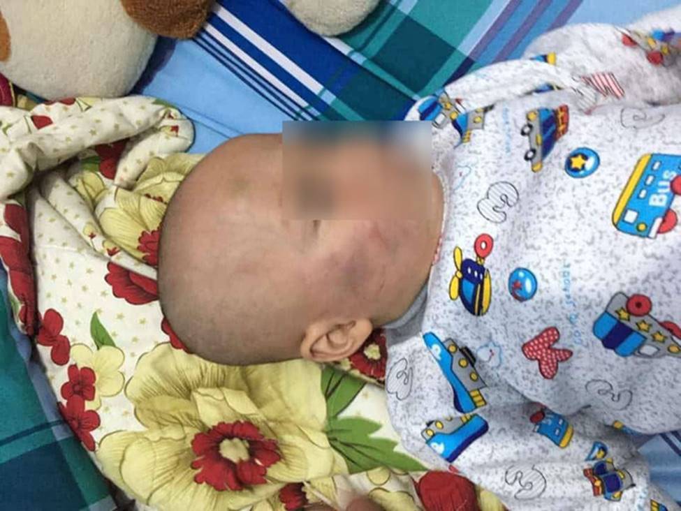 Vĩnh Long: Bé trai 19 tháng tuổi bị bảo mẫu tát liên tục vào mặt, phải nhập viện điều trị-4