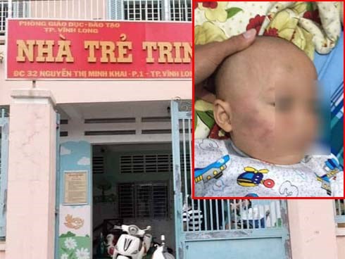 Vĩnh Long: Bé trai 19 tháng tuổi bị bảo mẫu tát liên tục vào mặt, phải nhập viện điều trị