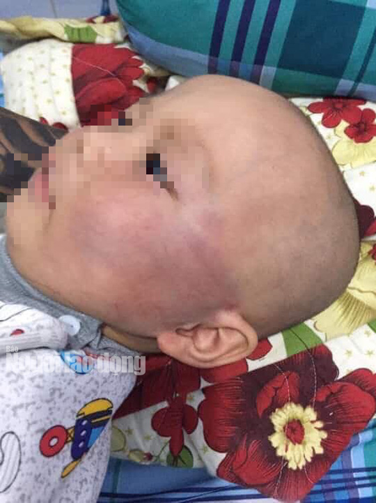 Tát bé trai 19 tháng sưng vù mặt, bảo mẫu nói dối bé té cầu thang-1
