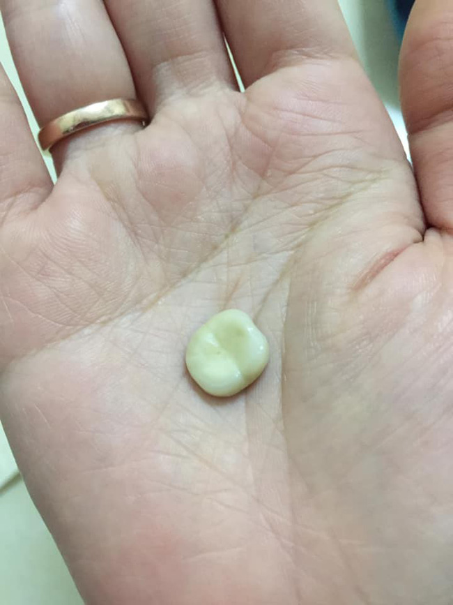 Một phút lỡ lầm cả đời ôm hận: Luộc chân gà ăn đêm, cô gái bay luôn chiếc răng cửa-3