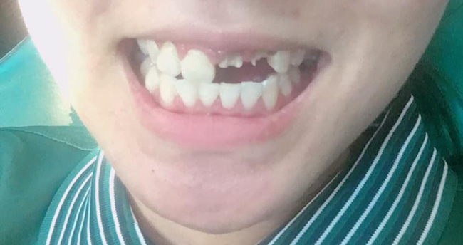 Một phút lỡ lầm cả đời ôm hận: Luộc chân gà ăn đêm, cô gái bay luôn chiếc răng cửa-4