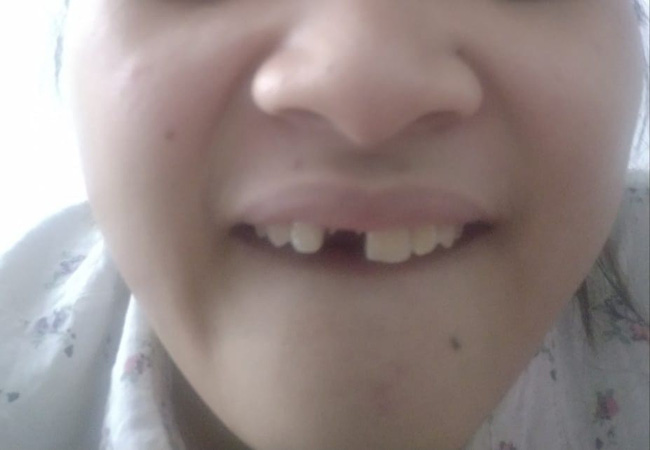 Một phút lỡ lầm cả đời ôm hận: Luộc chân gà ăn đêm, cô gái bay luôn chiếc răng cửa-5