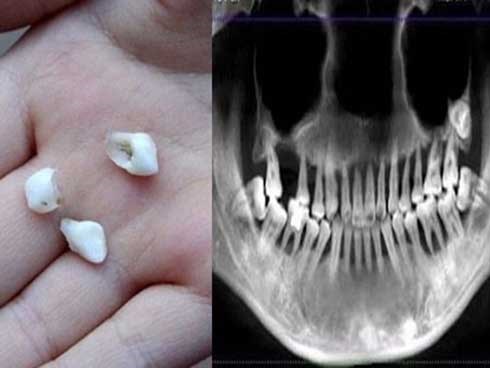 Cô gái 28 tuổi rụng răng, móm mém như cụ bà 80 vì thói quen xấu