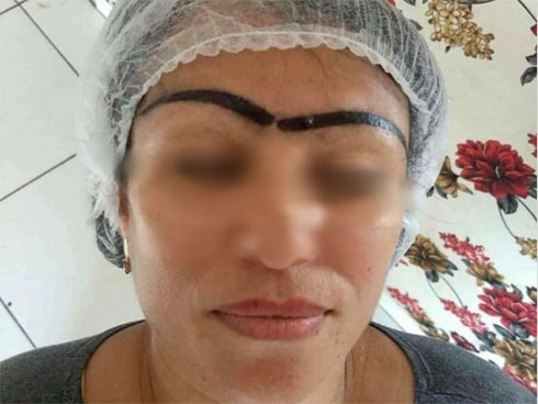 Xăm sai một li đi tận lên trán, người phụ nữ nhận về cặp lông mày tân dòng sông ly biệt hệt trò đùa-2