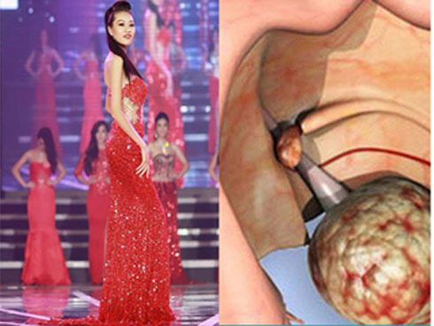 Rơi nước mắt số phận đáng thương người mẫu 9X bị ung thư buồng trứng-1