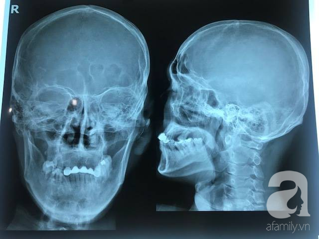 Ngã từ độ cao 8 mét xuống đất, người đàn ông bị chấn thương kinh hoàng, gãy xương từ đầu đến chân nguy kịch-1