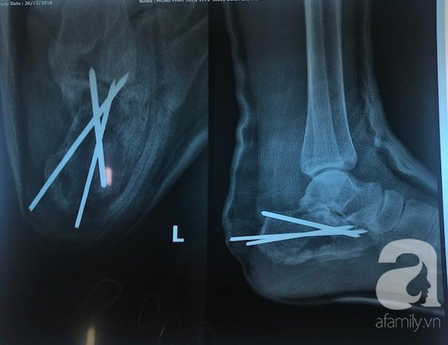 Ngã từ độ cao 8 mét xuống đất, người đàn ông bị chấn thương kinh hoàng, gãy xương từ đầu đến chân nguy kịch-2