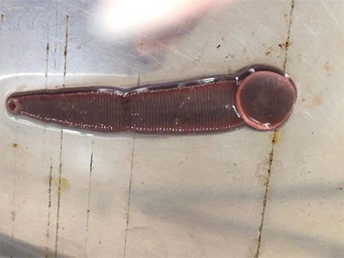 Con đỉa sống 3 tháng trong mũi người đàn ông-1