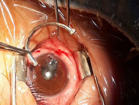 Nổi gai ốc xem video rút đinh dài cắm ngập trong mắt người đàn ông-1