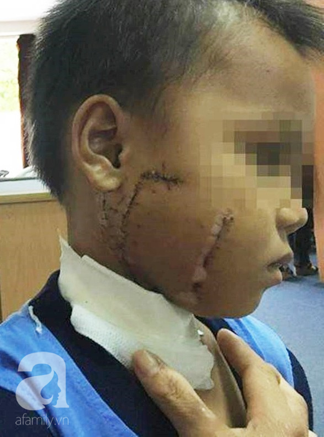 Thương tâm: Mẹ chở con không đội nón bảo hiểm, nhiều trẻ bị tai nạn cực nặng đến biến dạng mặt-4
