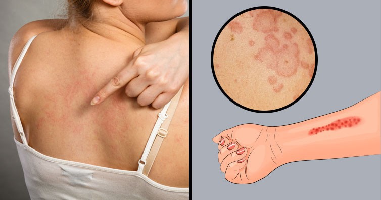 Cần làm gì để phòng tránh nguy cơ mắc chứng dị ứng cấp tính giống Hương Tràm trong thời tiết này?-8