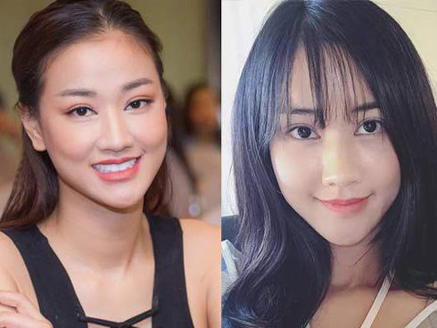 Bơm mỡ vào mặt như