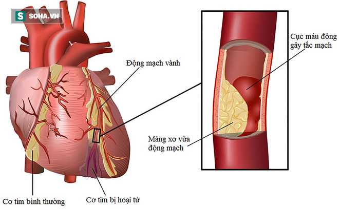 Người đang duy trì 3 thói quen này, hãy cảnh giác vì bệnh mỡ máu cao đang chờ trước cửa-1