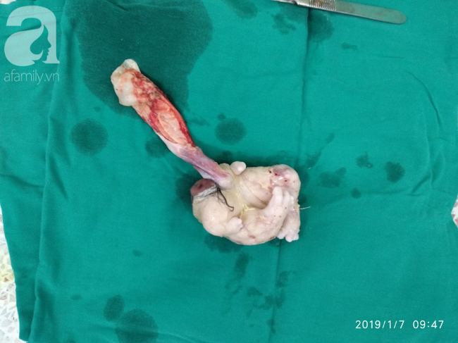 Hốt hoảng nhìn bé trai 4 tháng tuổi mang thai ký sinh vô cùng hiếm gặp, nửa triệu ca sinh mới có người mắc phải-3