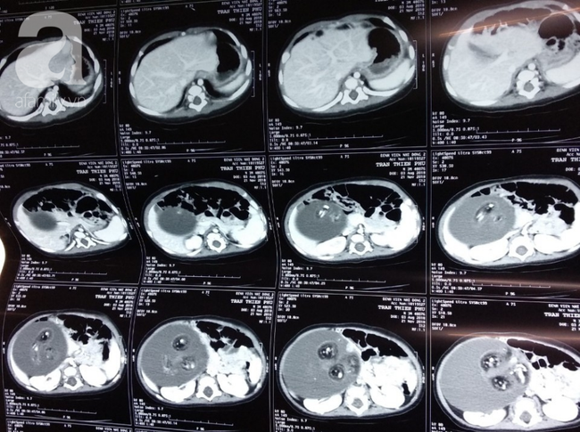 Hốt hoảng nhìn bé trai 4 tháng tuổi mang thai ký sinh vô cùng hiếm gặp, nửa triệu ca sinh mới có người mắc phải-1