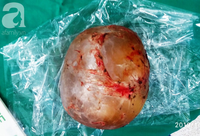 Hốt hoảng nhìn bé trai 4 tháng tuổi mang thai ký sinh vô cùng hiếm gặp, nửa triệu ca sinh mới có người mắc phải-5