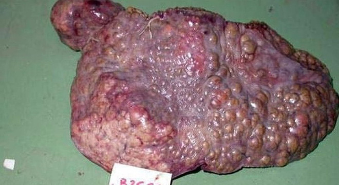 Chuyên gia hàng đầu về gan mật: 2 thủ phạm gây ung thư gan cực kỳ phổ biến ở Việt Nam-2