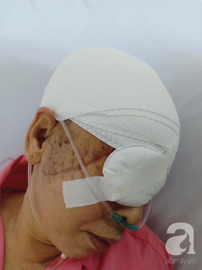 Theo con vào Bình Dương làm mướn, người phụ nữ bị máy kéo sợi bún lóc nát da đầu, cán thủng mắt thương tâm-4