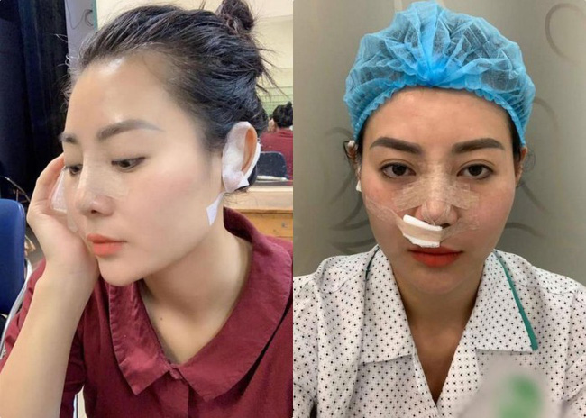 Nối gót Quỳnh búp bê, Thanh Hương - Lan cave cũng chạy theo mốt mặt dài cằm nhọn, lột xác thành người khác-5