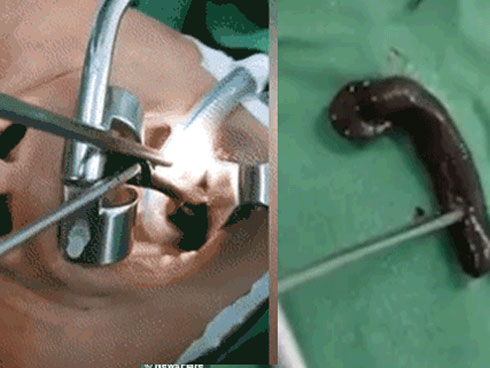 Rợn người cảnh dùng đỉa để trị liệu nhân dịp năm mới-1