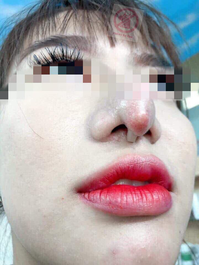 Chọn nhầm thẩm mĩ viện, cô gái xót xa vì chiếc mũi khoằm tệ hơn bản gốc-1