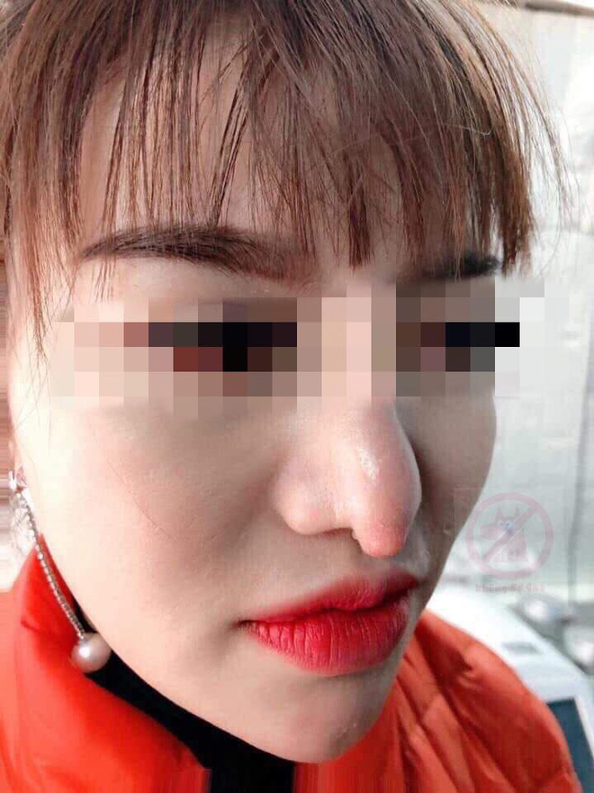 Chọn nhầm thẩm mĩ viện, cô gái xót xa vì chiếc mũi khoằm tệ hơn bản gốc-2