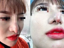 Chọn nhầm thẩm mĩ viện, cô gái xót xa vì chiếc mũi khoằm tệ hơn bản gốc Chọn nhầm thẩm mĩ viện, cô gái xót xa vì chiếc mũi khoằm tệ hơn bản gốc