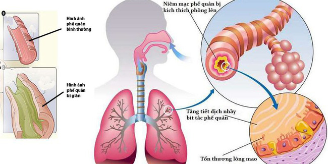 Từ triệu chứng đau thắt ngực, khó thở, cô sinh viên đã rất sốc khi biết phổi của mình trông như thế này-5