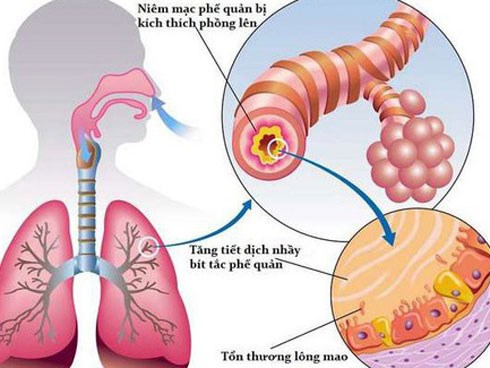 Từ triệu chứng đau thắt ngực, khó thở, cô sinh viên đã rất sốc khi biết phổi của mình trông như thế này