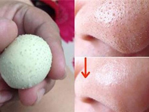 Cách trị mụn đầu đen tận gốc trả lại làn datrắng mịn tự nhiên