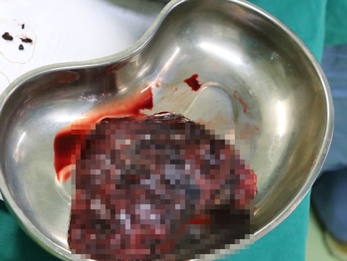 Người đàn ông được phát hiện ung thư phổi sau 10 ngày ho khan, cảnh báo dấu hiệu sớm của bệnh phải cẩn trọng-5