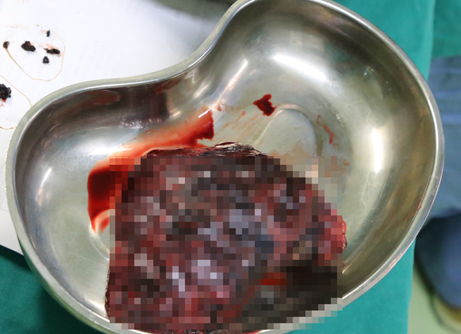 Phát hiện ung thư phổi sau 10 ngày ho khan không khỏi-1