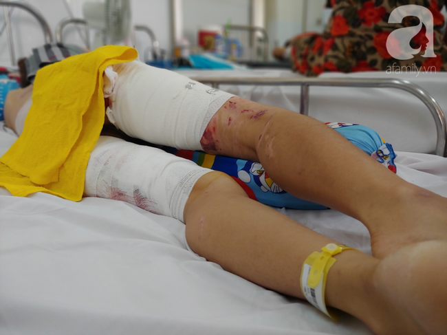 Vợ bị lửa xăng của chồng làm bỏng nặng sau cơn cuồng ghen: Em chỉ muốn làm lại từ đầu với anh ấy”-5