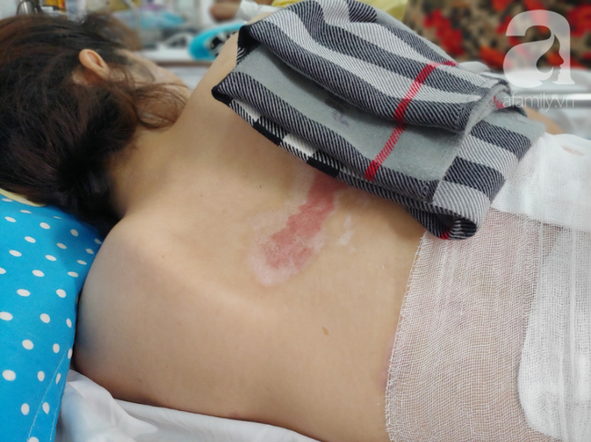 Vợ bị lửa xăng của chồng làm bỏng nặng sau cơn cuồng ghen: Em chỉ muốn làm lại từ đầu với anh ấy”-6