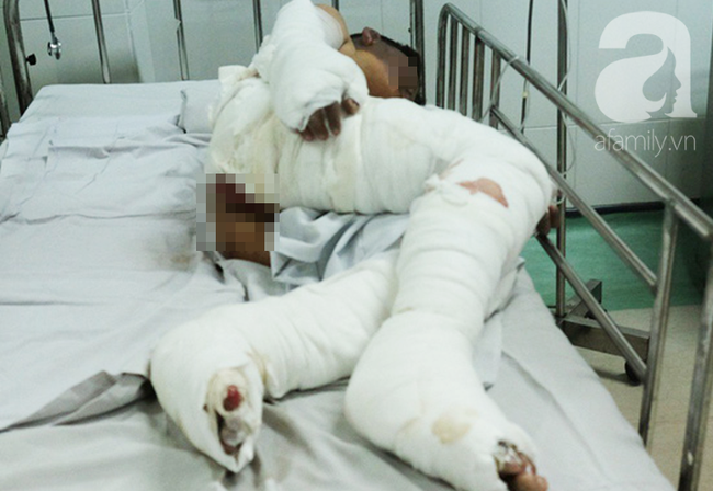 Thương tâm: Bình xăng cũ phát nổ trong đống rác, bé 28 tháng tuổi tử vong vì bỏng nặng-2