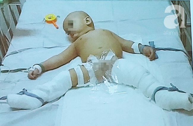 Ba hút thuốc trong nhà, con gái 10 tuổi bỏng rất nặng vì nổ bình gas-7