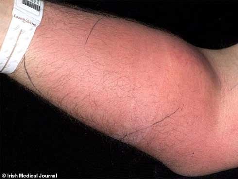 Tự tiêm tinh trùng vào tay người đàn ông 33 tuổi nhập viện gấp