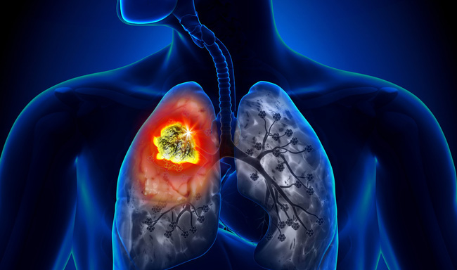 Người đàn ông được phát hiện ung thư phổi sau 10 ngày ho khan, cảnh báo dấu hiệu sớm của bệnh phải cẩn trọng-1
